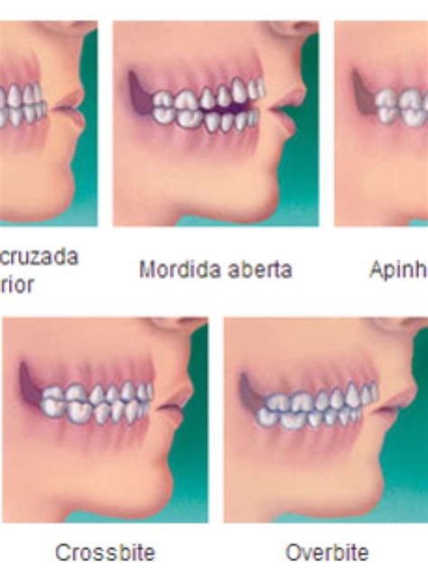 Mordida Correta Dos Dentes - insigniawoman