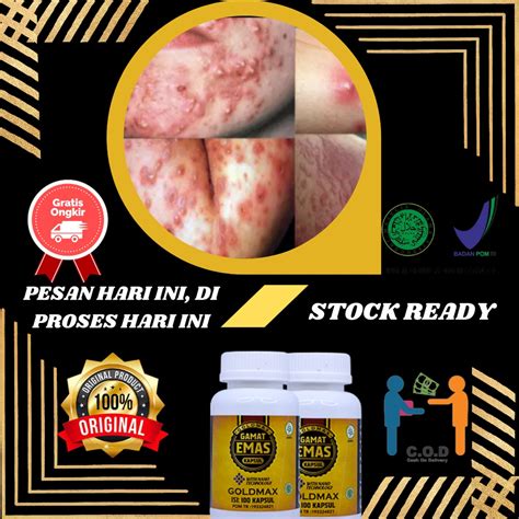 Jual Obat Gatal Obat Gatal Dan Panu Obat Gatal Gatal Dan Bisul