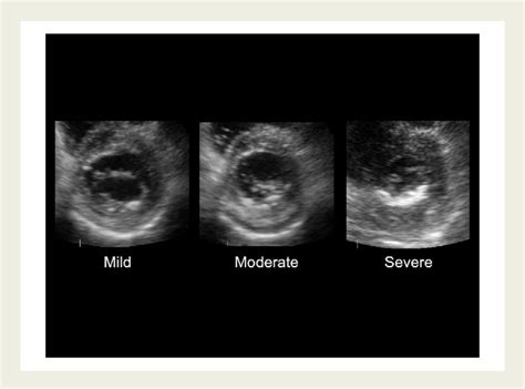 Figure From Association Of Mitral Annular Calcification And Aortic