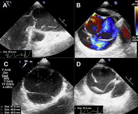 Perioperative Transesophageal Ultrasound Visualization Of The True And Download Scientific