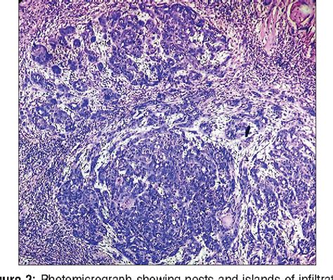 Figure 2 From Basaloid Squamous Cell Carcinoma Of Oral Cavity Report