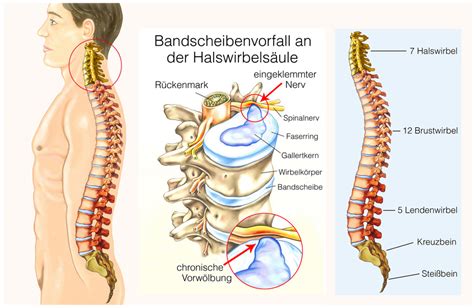 Bandscheibenvorfall Hws Lws Symptome Behandlung