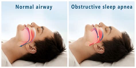 Sleep Apnea Oral Appliance Therapy Dentist