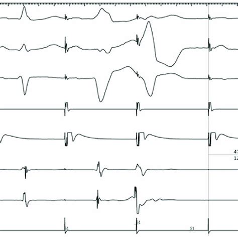 Intracardiac Electrogram Showing Initiation Of Left Bundle Branch Block