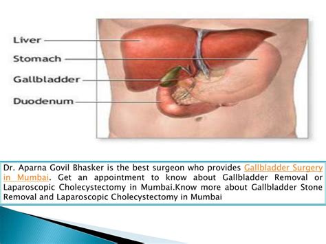 PPT Laparoscopic Surgery For Gall Bladder Stones In India PowerPoint