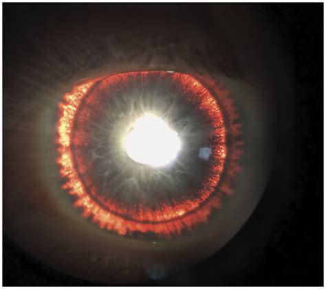 Rare genetic condition gives man Eye of Sauron look - Ars Technica