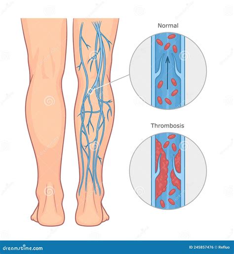 Deep Vein Thrombosis. Healthy Leg, And Leg With DVT. Sign And Symptoms