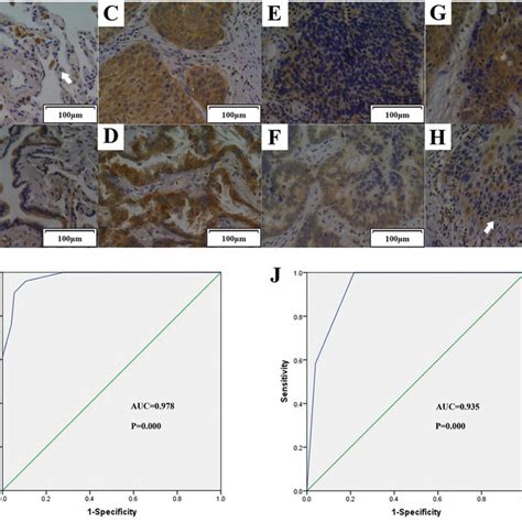 Tipe2 Expression In Normal Lung Tissue Tissue With Metaplasia Nsclc