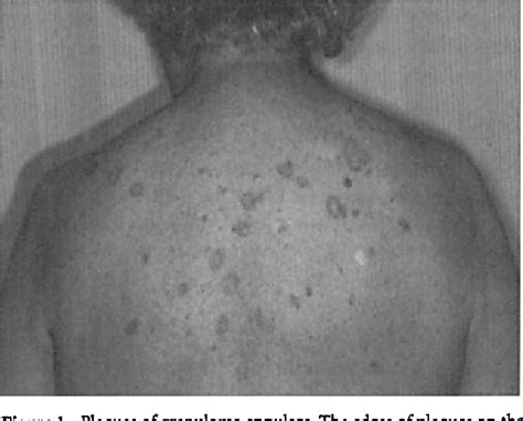 Figure 1 From Nerve Involvement In Granuloma Annulare Semantic Scholar