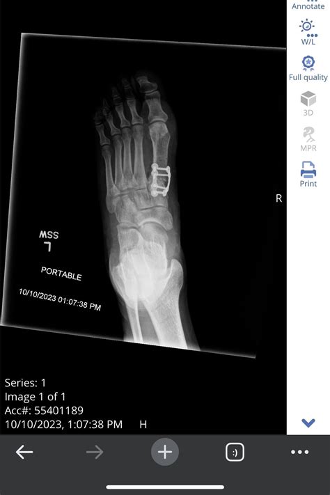 Before/After mini-incision system Lapiplasty : r/bunions