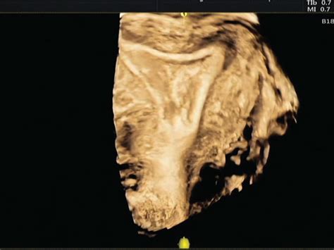 Female 32 Years Old A Endometrial Polyp Seen On Vaginal Ultrasound