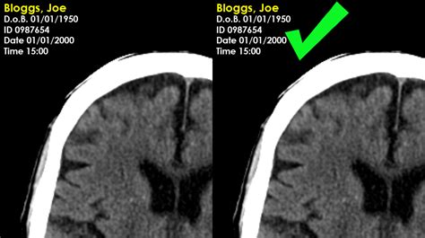 CT Head Interpretation For Beginners OSCE Guide, 55% OFF