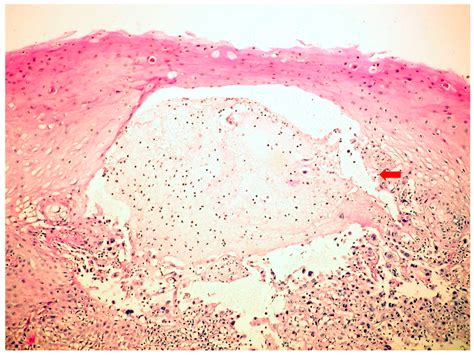 Cytomegalovirus (CMV)-induced esophagitis (microscopy-HE,... | Download ...