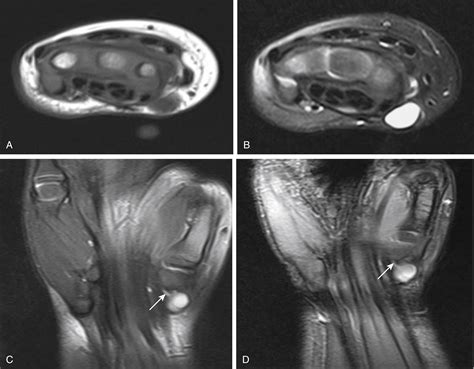 Approach To Pediatric Soft Tissue Masses Radiology Key