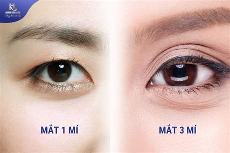 Nâng Cao Vẻ đẹp Qua Hình ảnh Mắt 1 Mí Và 3 Mí Khang Anh Clinic