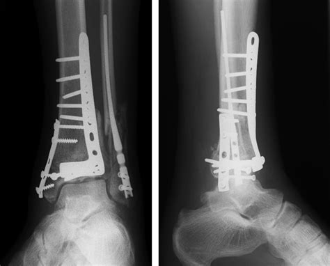 Type C Tibial Pilon Fractures Bone Joint