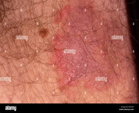 Fungal Skin Rash