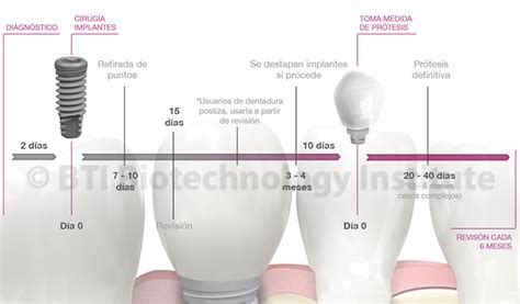 Fases y Duración del tratamiento IMPLANTES DENTALES DENTSRY