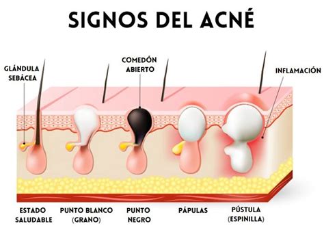 Acne Hormonal En Hombres Acne Hormonal En Hombres