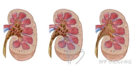 肾结晶会导致肾结石吗？ 知乎