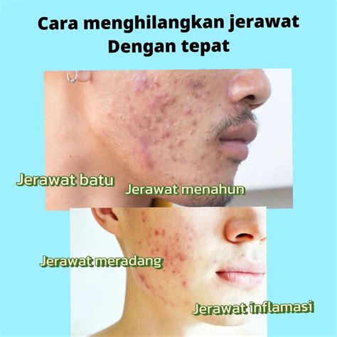 Cara Menghilangkan Jerawat Galeri Diposting Oleh Beauty Care Lemon