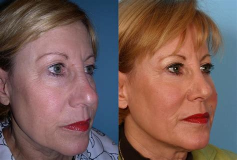 Patient 333526 Eyelid Surgery Blepharoplasty Before And After Photos Buckingham Center For