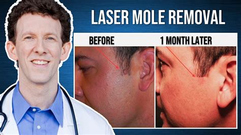 Laser Mole Removal Live Procedure Youtube