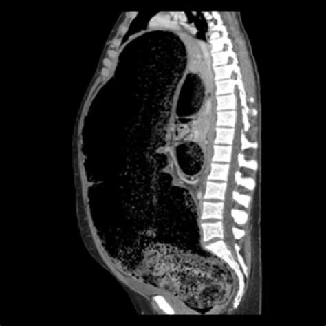 Preoperative Computed Tomography Scan Sagittal View Gross Dilatation