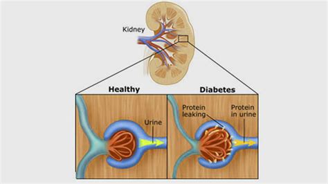 Diabetes and Chronic Kidney DiseaseAdvanced Diabetes Centre