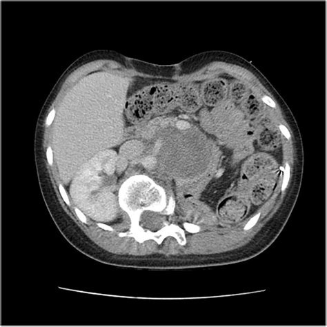 Abdominal Computed Tomography CT Revealing A Recurrent 8 3 6 5