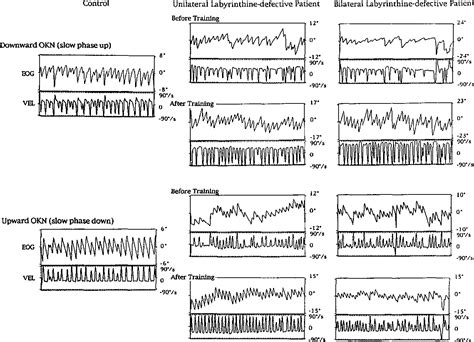 Figure From Modification Of Parameters In Vertical Optokinetic