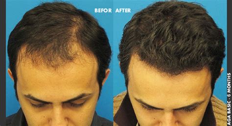 Aga Hair Regrowth Treatment