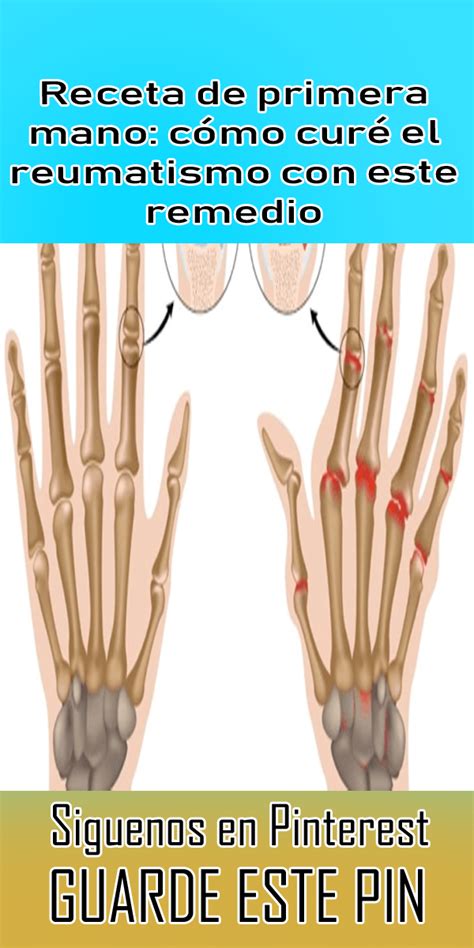 Receta De Primera Mano Cómo Curé El Reumatismo Con Este Remedio