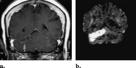 Infarct of the right superior cerebellar artery territory in a ...