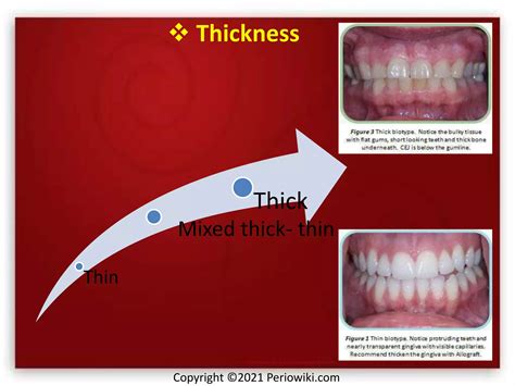 Attached gingiva and procedures for gingival augmentation | PPTX