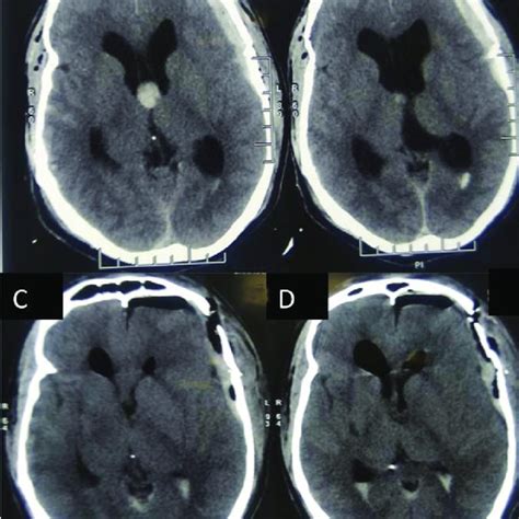 Follow-up brain MRI revealed no residual mass, but there is hemosiderin ...