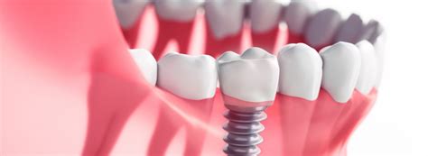 Dental Implants in Cheshire | Near Me | Harbour Dental