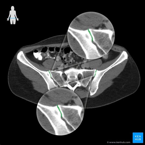 Sacroiliac Joint Anatomy And Ligaments Kenhub