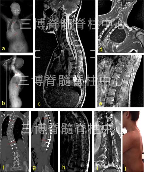 范涛教授团队：长节段脊髓内星形细胞瘤合并脊柱侧弯的手术报告2例 脑医汇 神外资讯 神介资讯