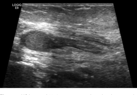 Figure 1 From Ultrasound Guided Continuous Radiofrequency Ablation Of