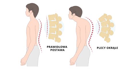 Wady Postawy U Dzieci Rodzaje Przyczyny Leczenie