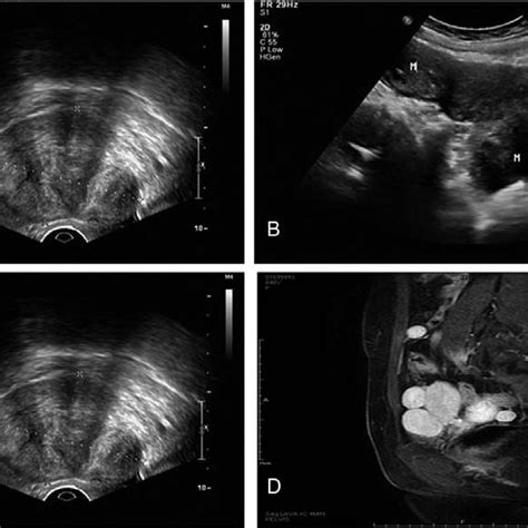 Ultrasound And Mri Images Of Case 3 A B Ultrasound Showed Multiple