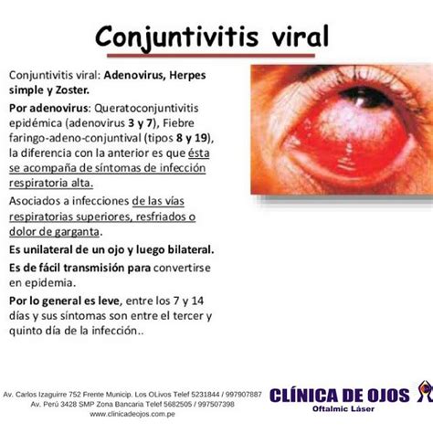 Clínica de Ojos Oftalmic Láser CONJUNTIVITIS VIRAL