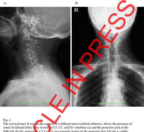 Figure From Polyostotic Fibrous Dysplasia Imaging Findings Of A