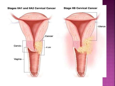 Carcinoma Cervix Ppt