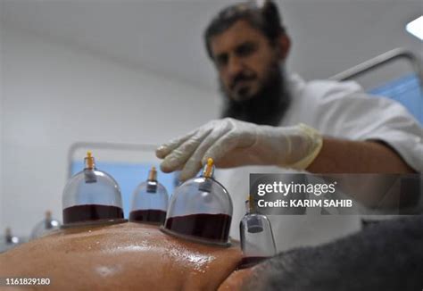 74 Wet Cupping Therapy Stock Photos High Res Pictures And Images