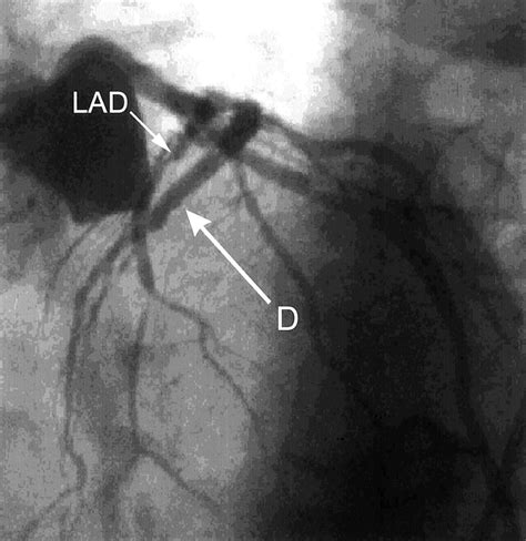 Percutaneous In Situ Coronary Venous Arterialization Circulation