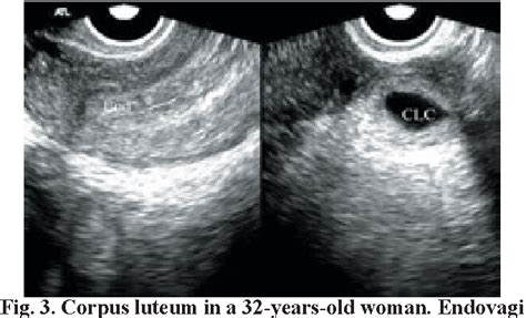 Figure 3 From Tubal Ring Sign Of Ectopic Pregnancy Versus Corpus Luteum Cyst Best Sonographic