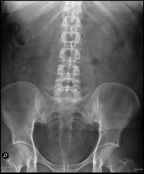 Bloc dun Metge de Família 8 signes clau en les radiografies d abdomen