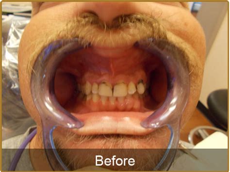 Teeth Cleaning Dentistry Teeth Deep Cleaning Before And After Dentures